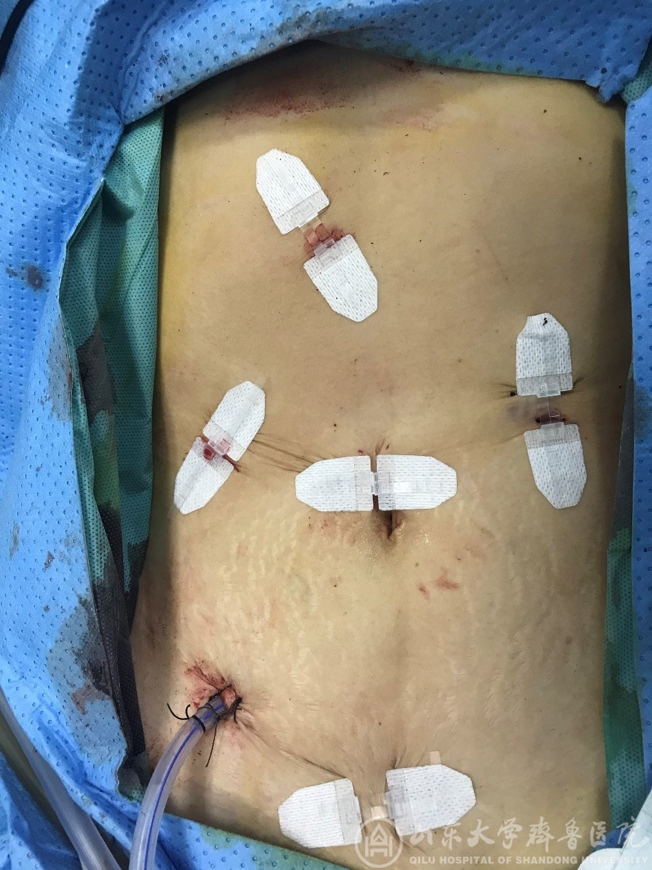 肛肠外科成功实施我院首例腹腔镜肠癌肝转移一期切除和保留回盲部结肠次全切除NOSES手术