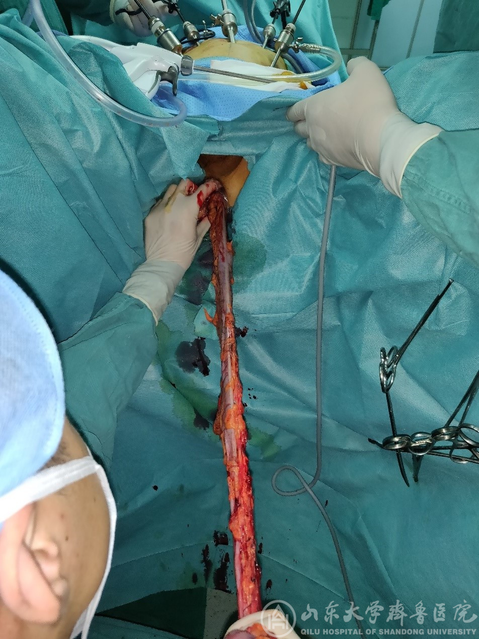 肛肠外科成功实施我院首例腹腔镜肠癌肝转移一期切除和保留回盲部结肠次全切除NOSES手术