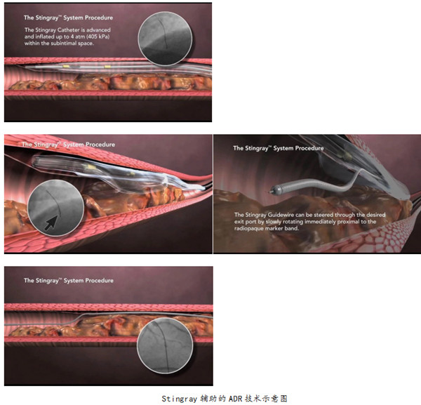 绿帽社完成山东省内首例stingray球囊辅助的ADR术