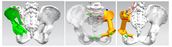 手术机器人与3D打印技术联合应用,骨肿瘤患者重燃生命希望