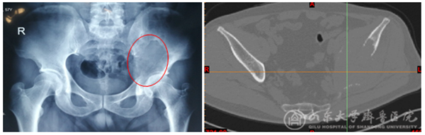 手术机器人与3D打印技术联合应用,骨肿瘤患者重燃生命希望