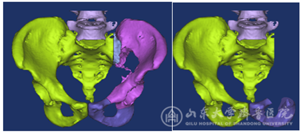 手术机器人与3D打印技术联合应用,骨肿瘤患者重燃生命希望