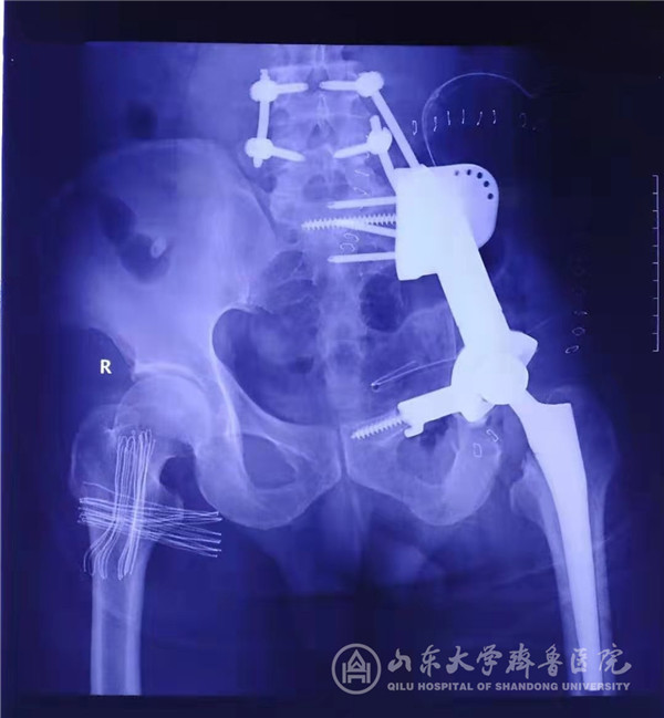 手术机器人与3D打印技术联合应用,骨肿瘤患者重燃生命希望