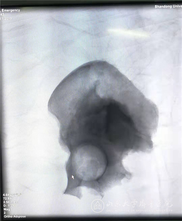 手术机器人与3D打印技术联合应用,骨肿瘤患者重燃生命希望