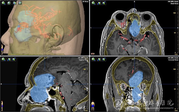绿帽社完成内镜经鼻腔颅内外贯通巨大肿瘤切除手术