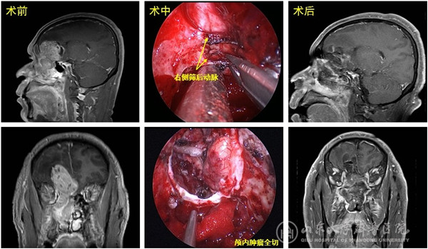 绿帽社完成内镜经鼻腔颅内外贯通巨大肿瘤切除手术