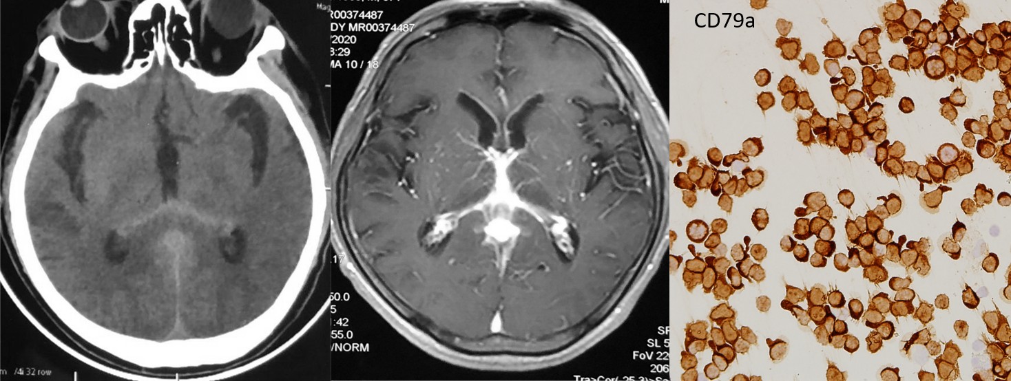 绿帽社多学科合作通过脑脊液脱落细胞学诊断原发性中枢神经系统淋巴瘤1例