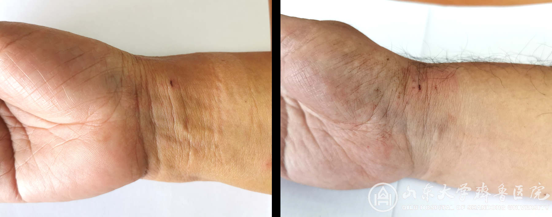 绿帽社
神经外科开展“经桡动脉全脑血管造影日间手术”